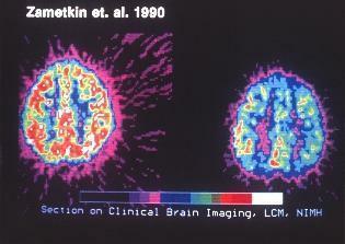 klīniska smadzeņu attēlveidošanas skenēšana adhd