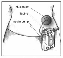 Insulīna pumpis