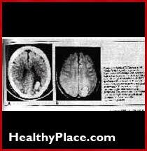 Neirologs Džons Frīdenbergs, kā psihiski medikamenti un elektrošoks bojā smadzenes. Viņš saka, ka visi cieš no smadzeņu bojājumiem un atmiņas zuduma.