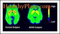 Termini ADD un ADHD ir lietoti savstarpēji aizvietojami. Tomēr atjauninātais termins saskaņā ar DSM IV ir ADHD (uzmanības deficīta hiperaktivitātes traucējumi).